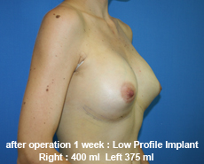 plastic-surgery-breast-augmentation
